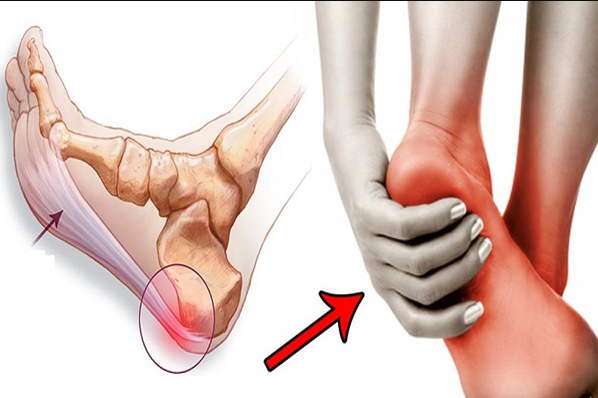 Vị trí đau thường gặp ở gót chân.