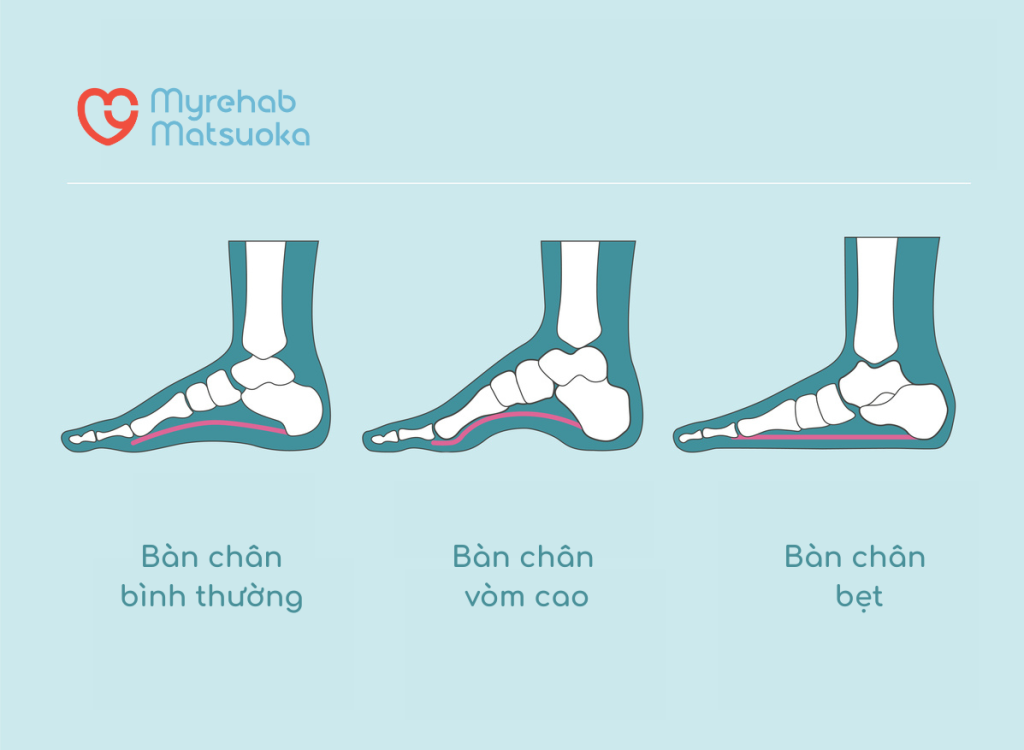 Dấu hiệu đặc trưng của bàn chân bẹt