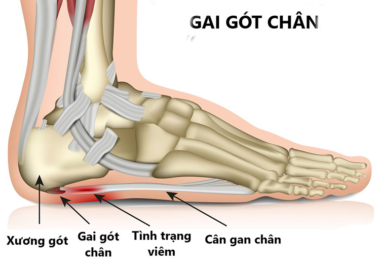 Hình ảnh gai gót chân kèm theo viêm mô mềm xung quanh.