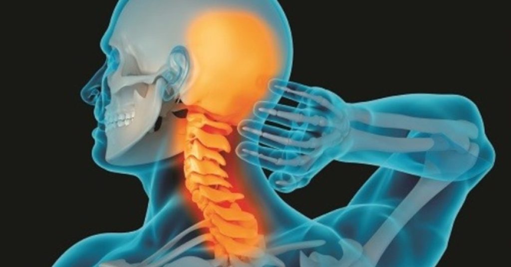 Thoái hoá đốt sống cổ làm hẹp khe khớp