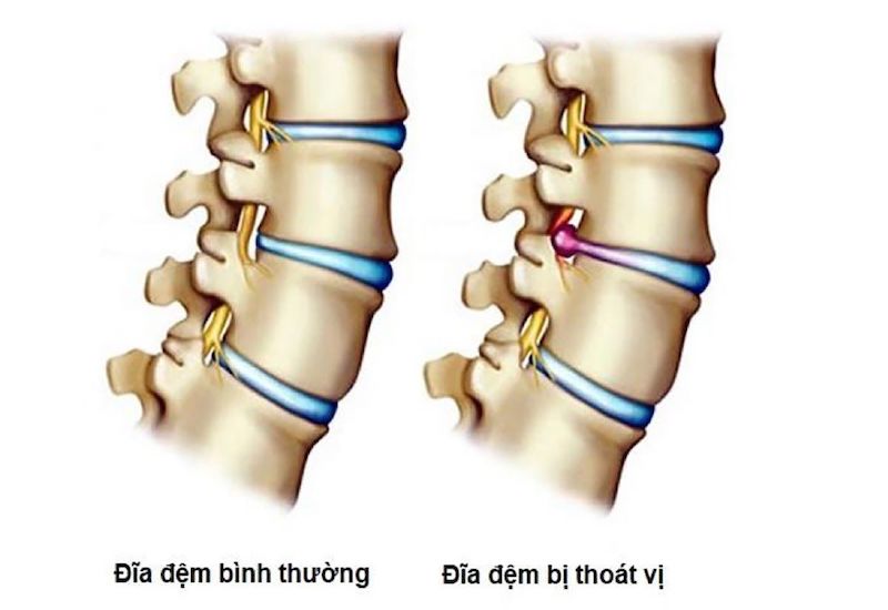 Hình ảnh so sánh giữa đĩa đệm bình thường và đĩa đệm thoát vị.