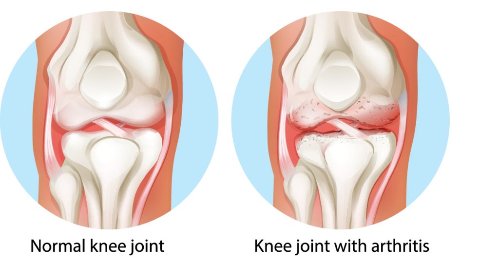 So sánh khớp gối khỏe mạnh và khớp gối bị viêm