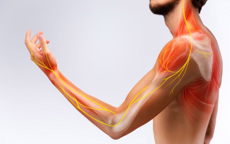 Hội chứng cổ vai cánh tay do chèn ép thần kinh. 