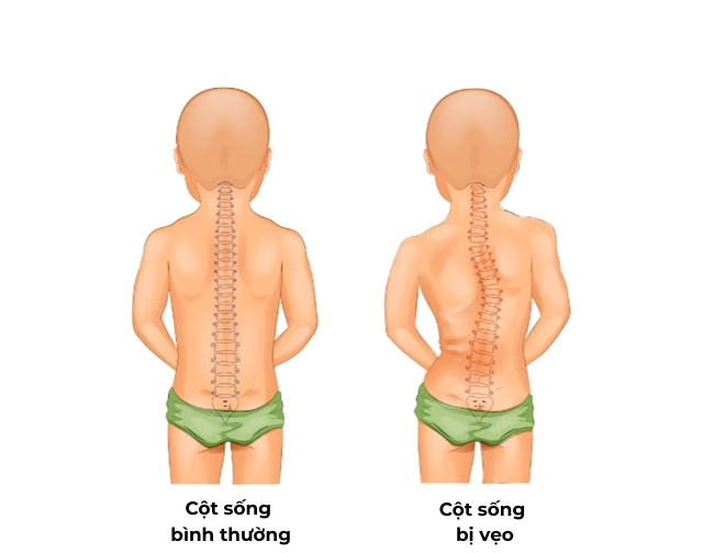 Vai lệch là dấu hiệu của cong vẹo cột sống