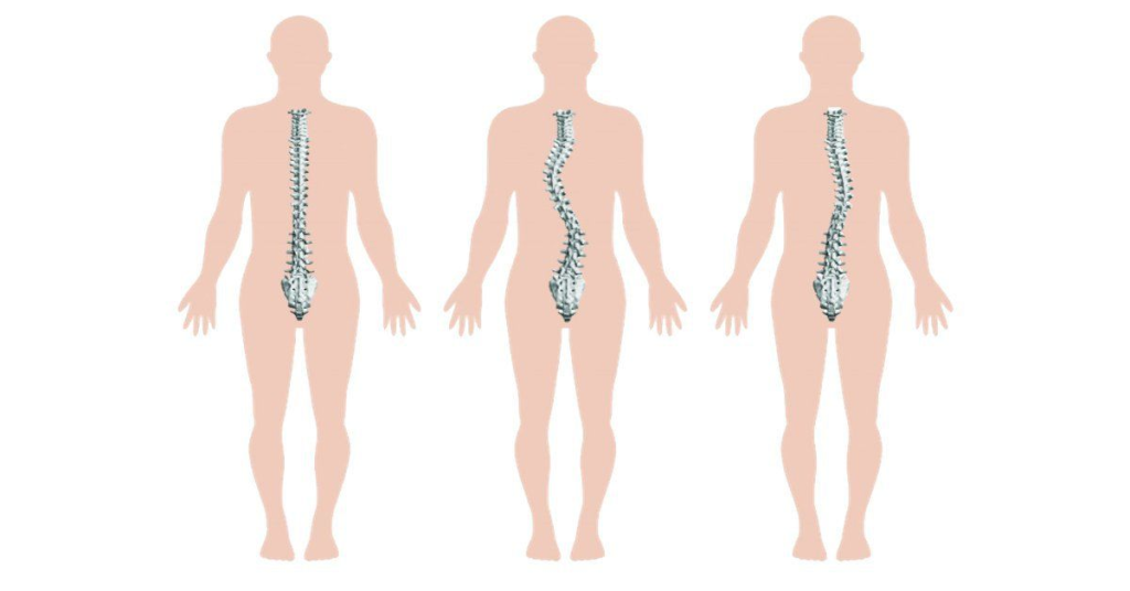 Biến chứng vẹo cột sống gây hậu quả nghiêm trọng tới sức khỏe