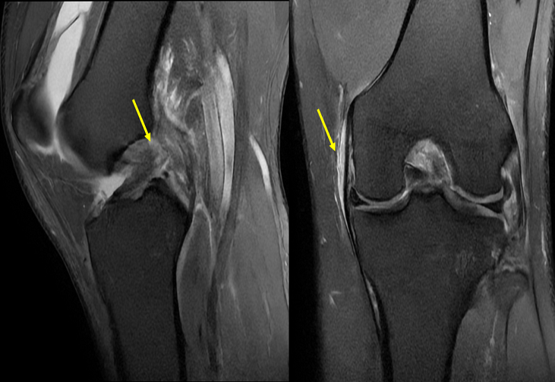 Chụp MRI phát hiện tổn thương dây chằng chéo trước