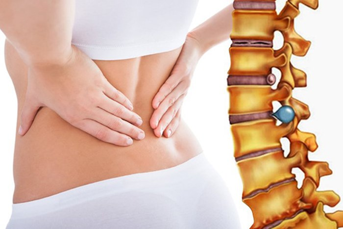 Phát hiện sớm thoát vị địa đệm để nâng cao hiệu quả điều trị