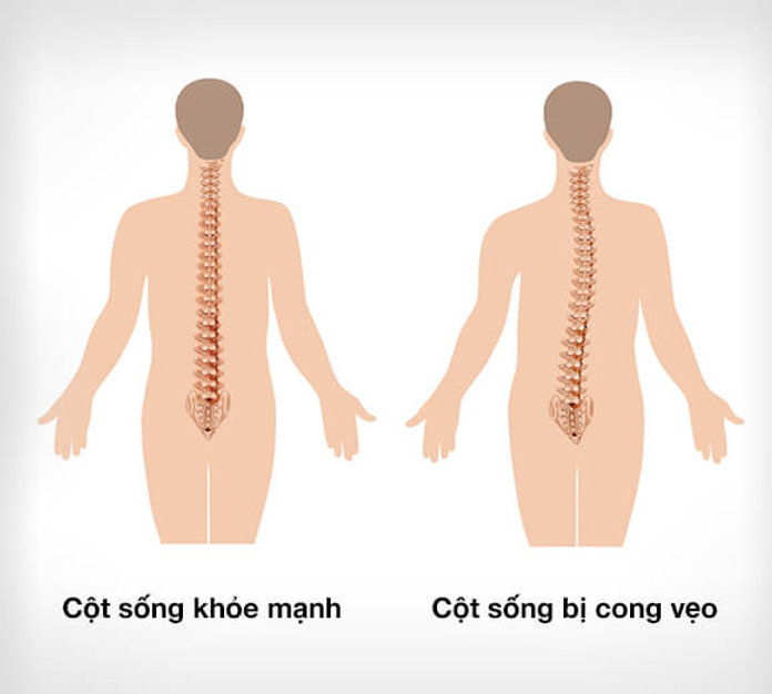 Tình trạng lệch vai, lệch hông