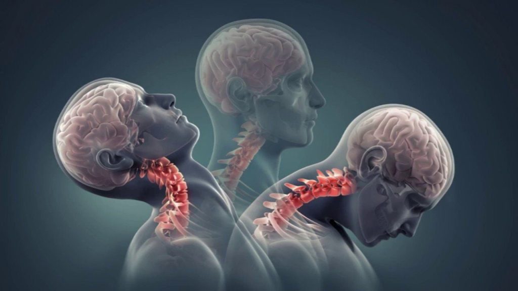 Tỷ lệ thoái hóa cột sống cổ ở người trẻ đang gia tăng nhanh chóng