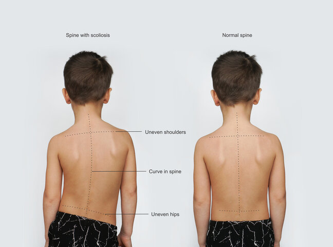 Cột sống bị vẹo (trái) với phần vai hông bị lệch, cột sống cong