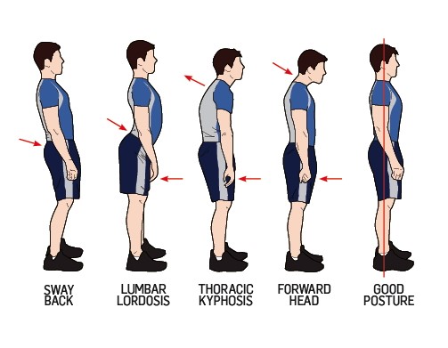 Tư thế đứng chuẩn giúp giảm nguy cơ tái phát bệnh