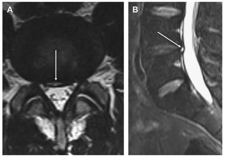 Chụp MRI hình ảnh thoát vị
