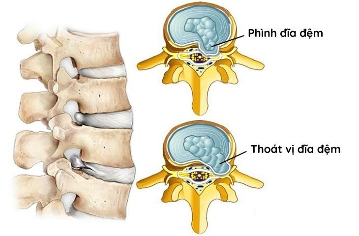 Sự khác biệt giữa phồng và thoát vị đĩa đệm