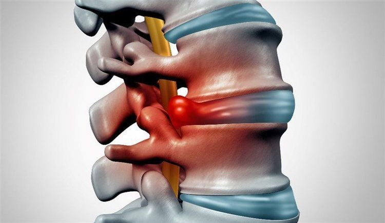 Tình trạng phồng lồi đĩa đệm