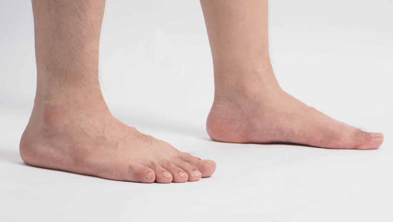 Bàn chân bẹt ở người lớn
