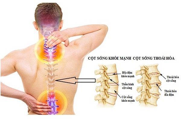 So sánh cột sống bị thoái hoá và cột sống khoẻ mạnh
