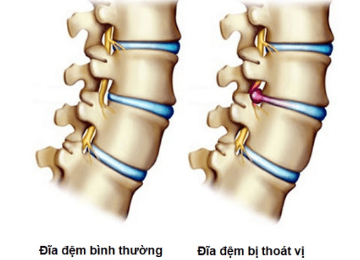 Sự khác biệt giữa đĩa đệm bình thường và đĩa đệm bị thoát vị