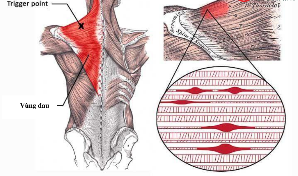 Trigger point được hình thành trong sợi cơ hoặc cân cơ gây đau cơ ngực