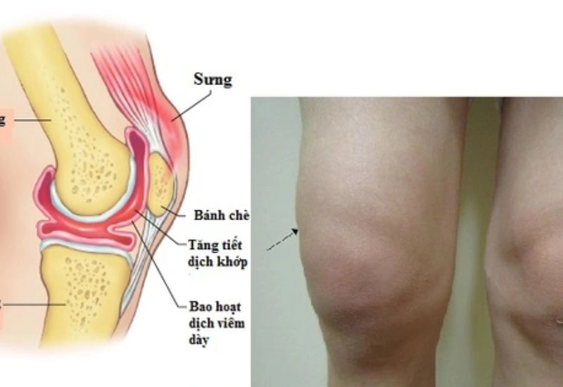 Chấn thương phần mềm trong chấn thương thể thao