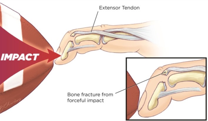Tổn thương gân duỗi bàn ngón tay - chấn thương gân - cơ