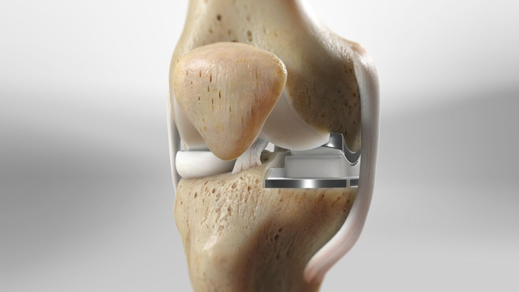 Thay khớp gối bán phần 