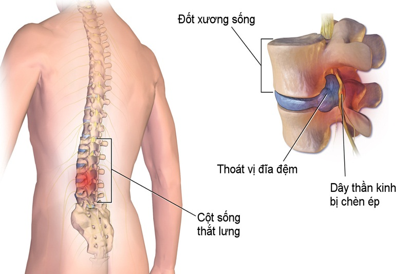 Tình trạng thoái hoá cột sống
