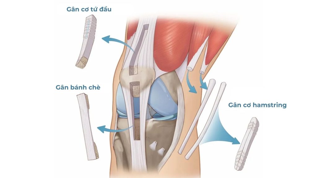 Sử dụng vật liệu tái tạo tự thân từ các gân khác trên cơ thể người bệnh