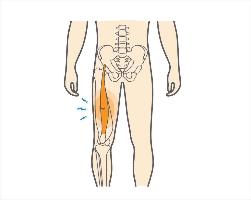 Căng cơ tứ đầu đùi có thể khiến các sợi cơ bị rách theo nhiều cấp độ