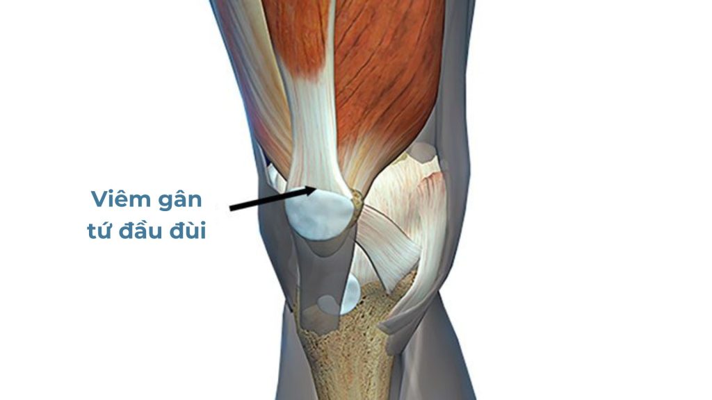 Viêm gân tứ đầu đùi diễn ra khi phải chịu lực lớn hoặc lặp đi lặp lại hoạt động