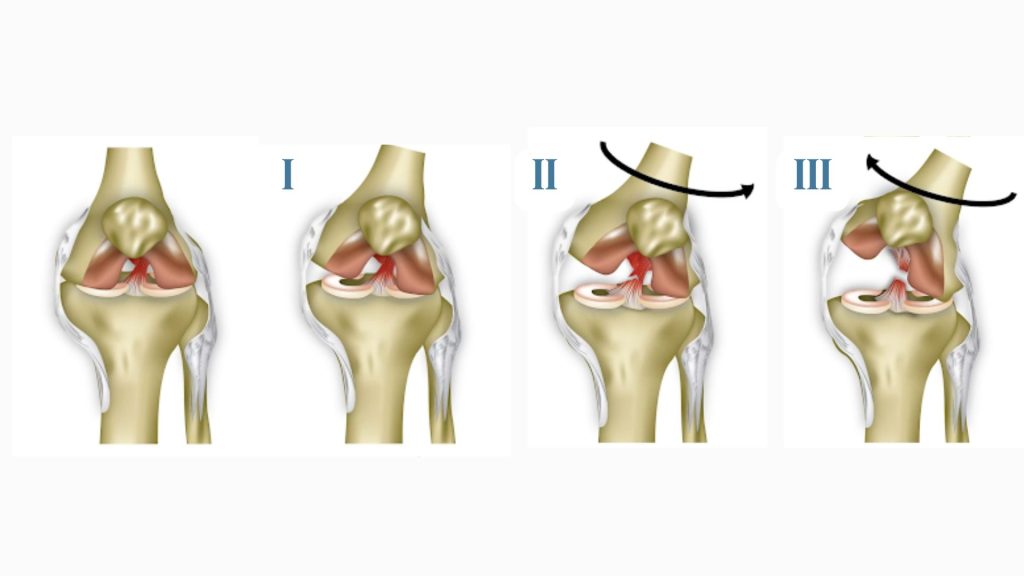 Các mức độ chấn thương dây chằng chéo trước mà bạn cần lưu ý