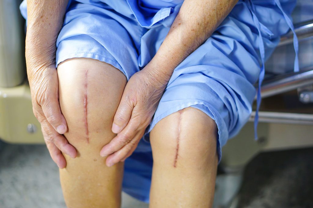 Phẫu thuật được áp dụng cho các trường hợp tổn thương dây chằng nghiêm trọng