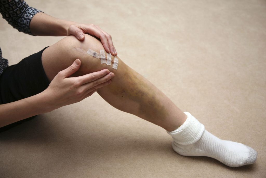 Người bệnh có nguy cơ bị lỏng gối sau mổ dây chằng chéo trước