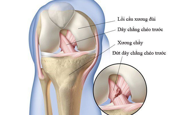 Chấn thương đứt dây chằng chéo trước