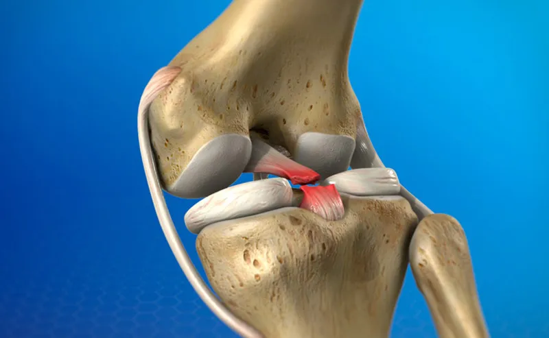 Khớp gối bị đứt dây chằng chéo sau