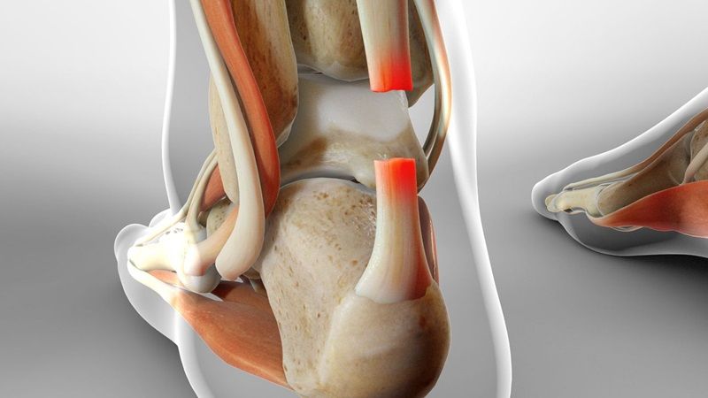 Đứt gân Achilles toàn phần