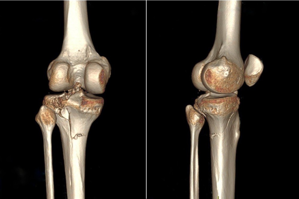 Phát hiện gãy xương nhờ phim chụp CT