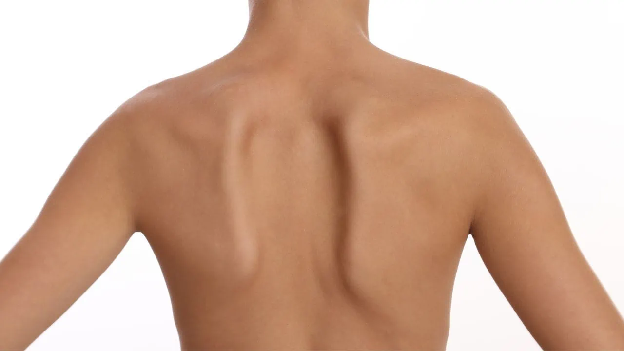 Tình trạng rối loạn vận động bả vai