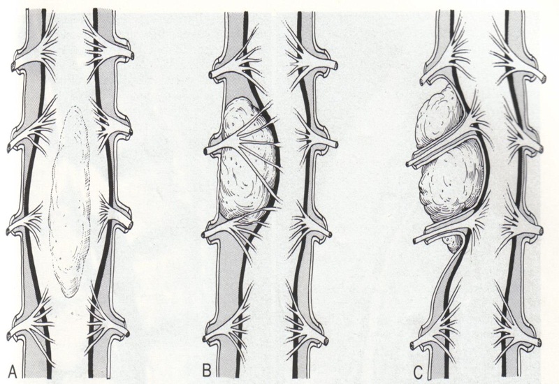 Các dạng u tủy sống