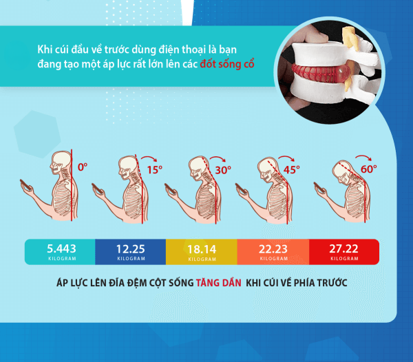 Áp lực lên đĩa đệm cột sống tăng dần khi cúi về phía trước