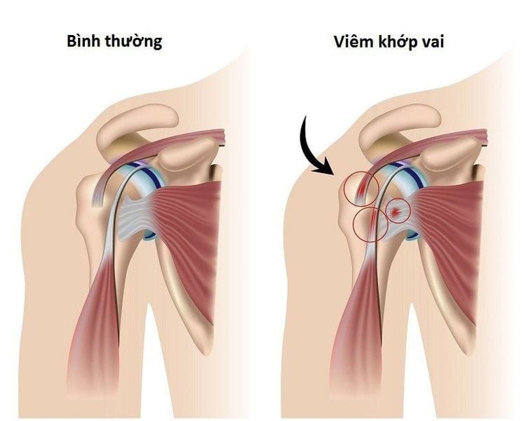 Tình trạng viêm khớp vai