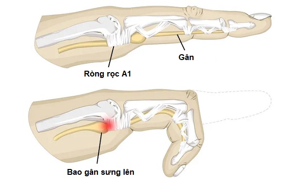 Tổn thương bao gân bàn tay