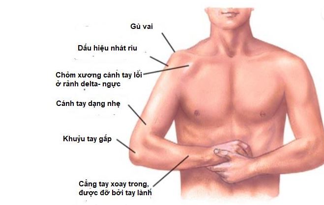 Dấu hiệu nhận biết khi bị trật khớp vai