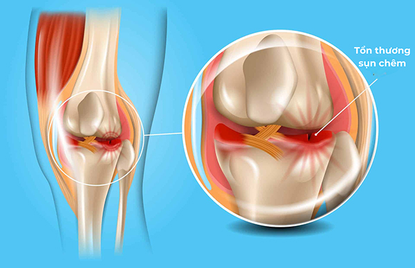 Tình trạng chấn thương đầu gối - tổn thương dây chằng và sụn chêm