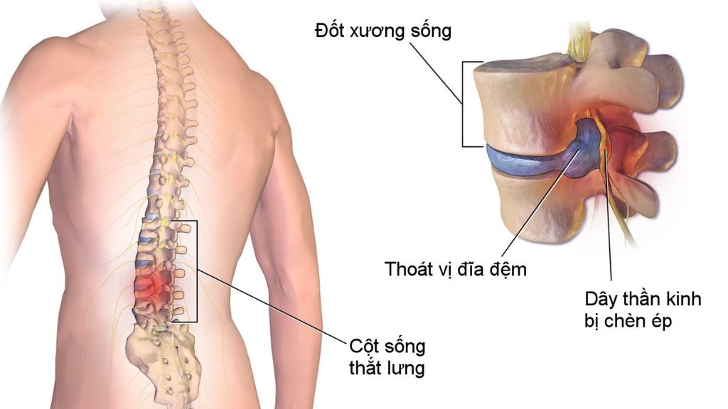Tình trạng thoát vị đĩa đệm là nguyên nhân gây nên đau thần kinh toạ