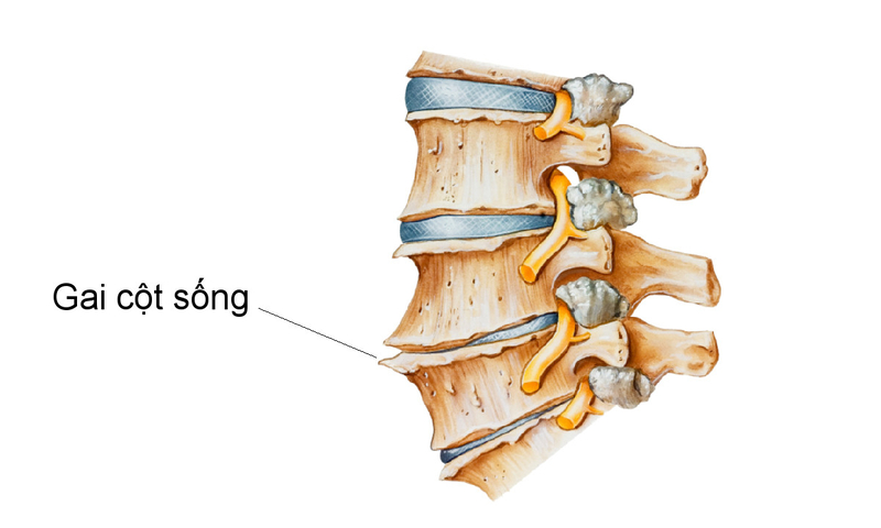 Tình trạng gai cột sống