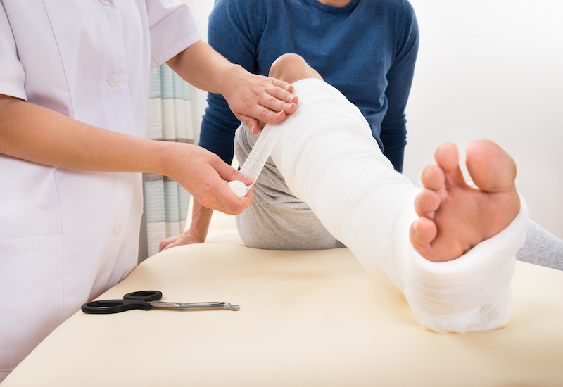 Điều trị gãy xương mác bằng bó bột