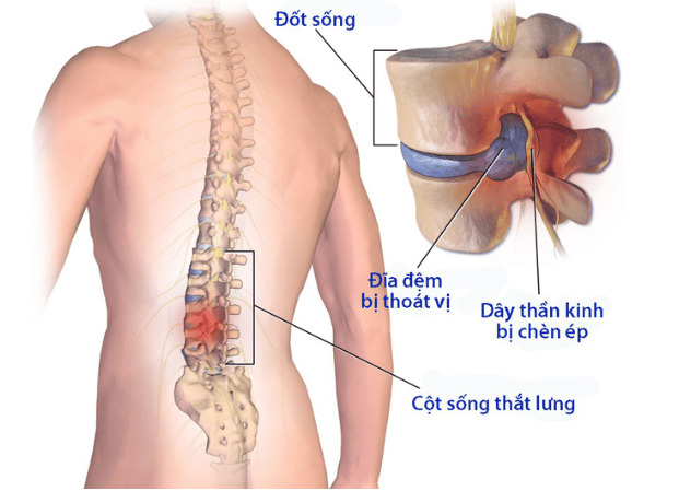 So sánh về đĩa đệm bình thường và bị thoát vị
