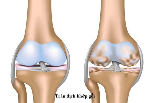 Tình trạng tràn dịch khớp gối tái phát