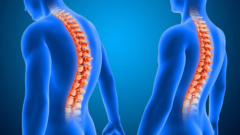 Cột sống lưng trên chịu áp lực lớn do gù lưng
