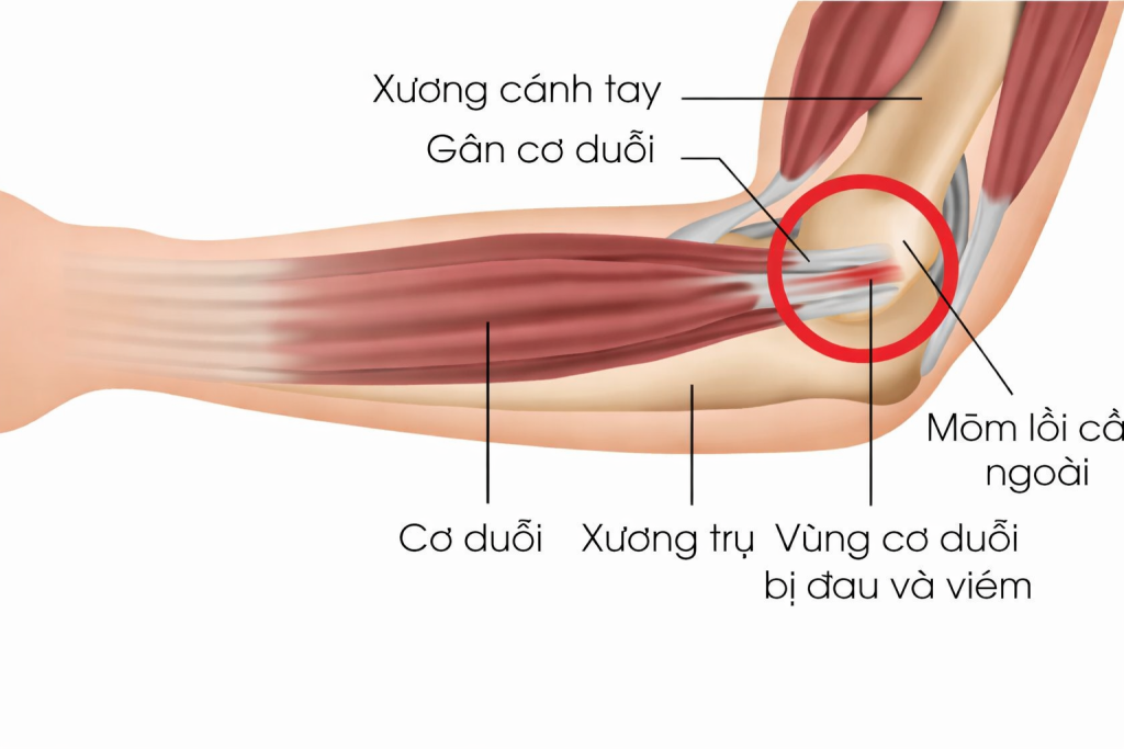 Viêm lồi cầu ngoài xương cánh tay